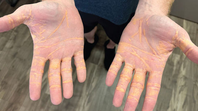 ダイエットで1日あたり約2.7kg〜4kgのチーズやバターを摂取した男性、病院を受診